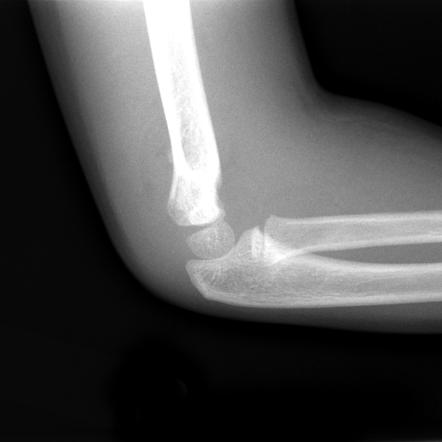 Gartland classification of supracondylar humeral fractures | Radiology ...