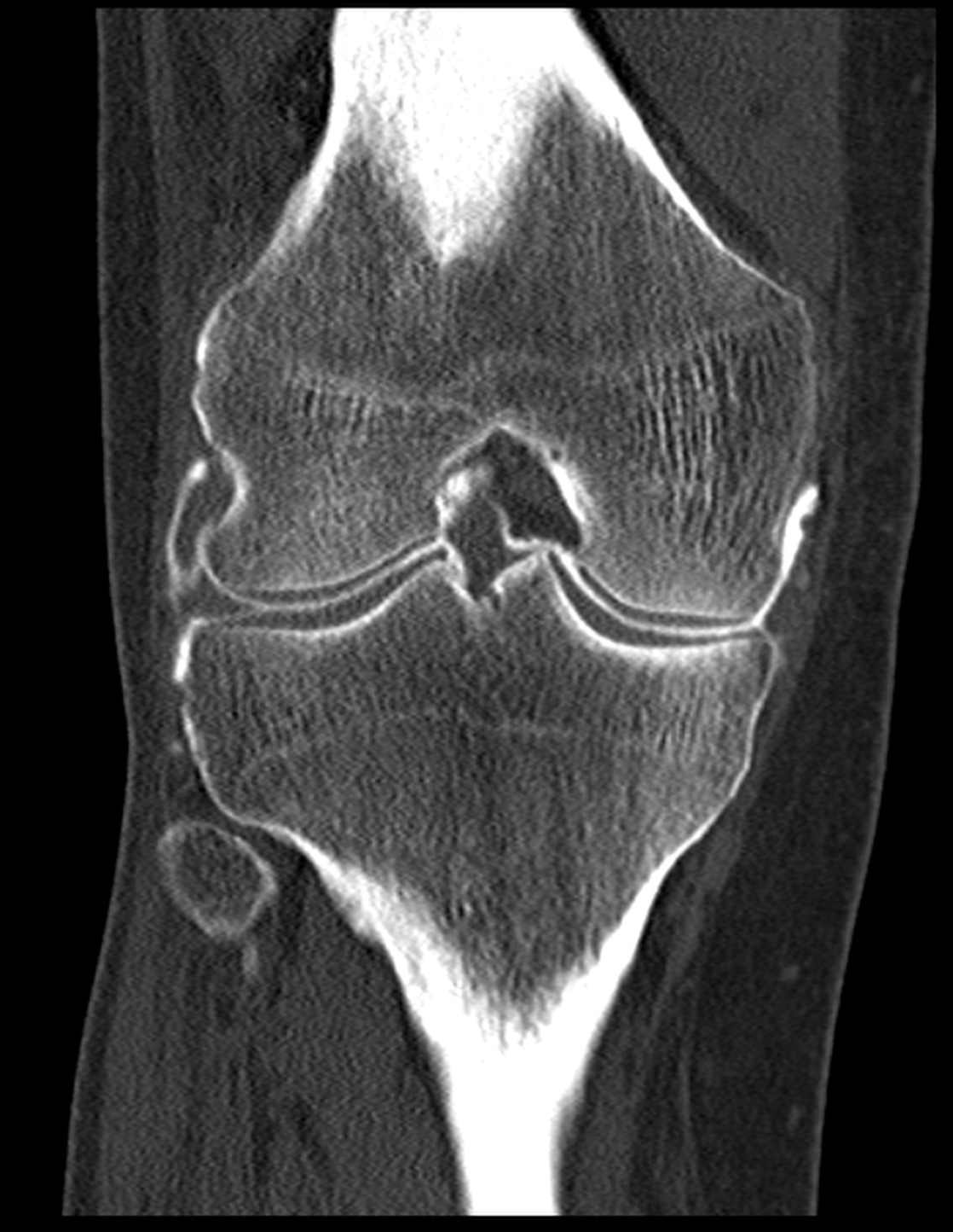 Medial meniscus flap tear (CT arthrogram) | Image | Radiopaedia.org