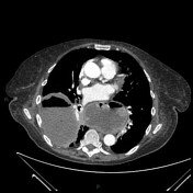 Lung abscess | Radiology Reference Article | Radiopaedia.org