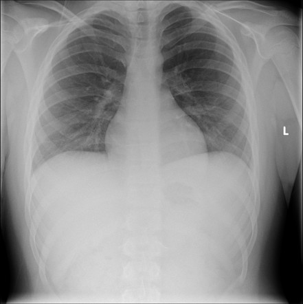 Clavicle fracture (on chest radiograph) | Radiology Case | Radiopaedia.org