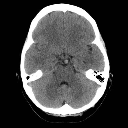 Basilar tip aneurysm | Radiology Case | Radiopaedia.org