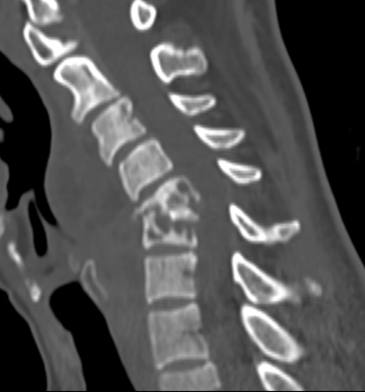 Cervical spondylodiscitis | Image | Radiopaedia.org