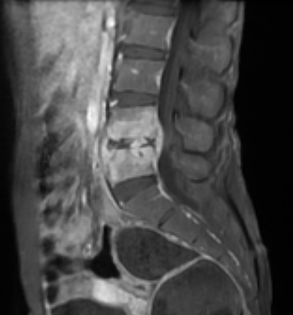 Spondylodiscitis - Lumbar Spine | Radiology Case | Radiopaedia.org