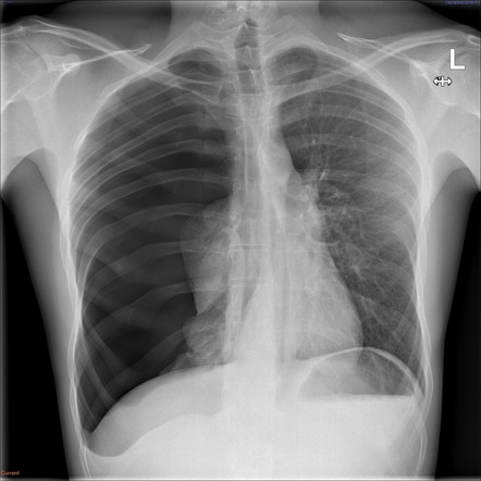 Tension pneumothorax | Radiology Case | Radiopaedia.org