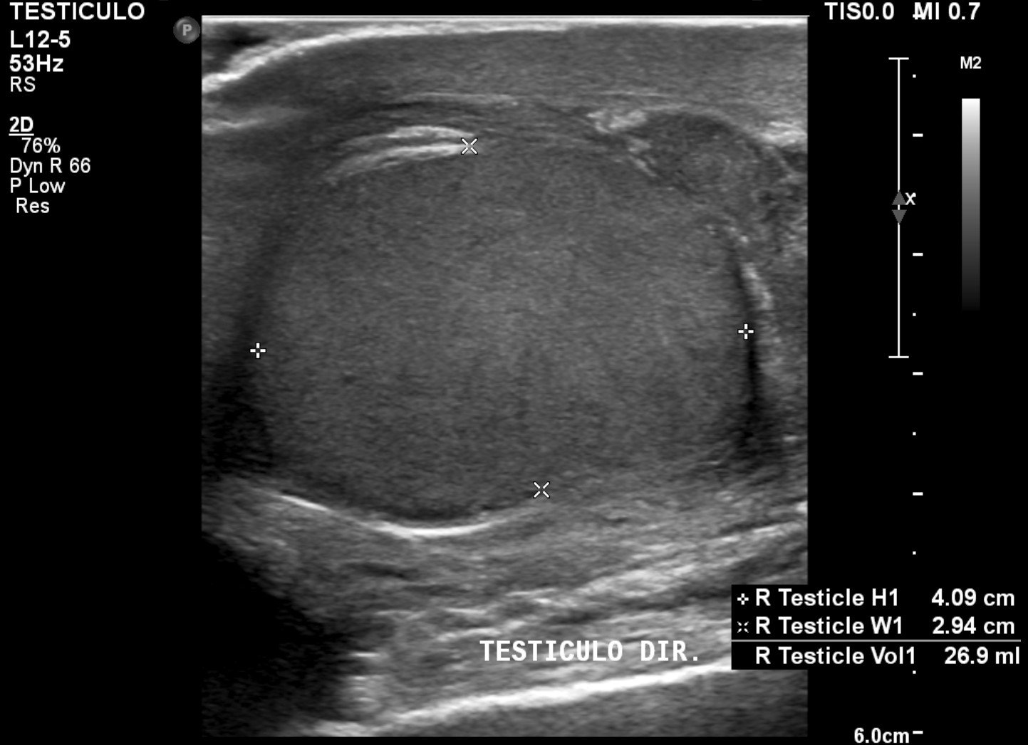 Scrotal Mass Ultrasound