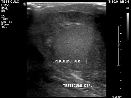 Epididymo-orchitis | Image | Radiopaedia.org