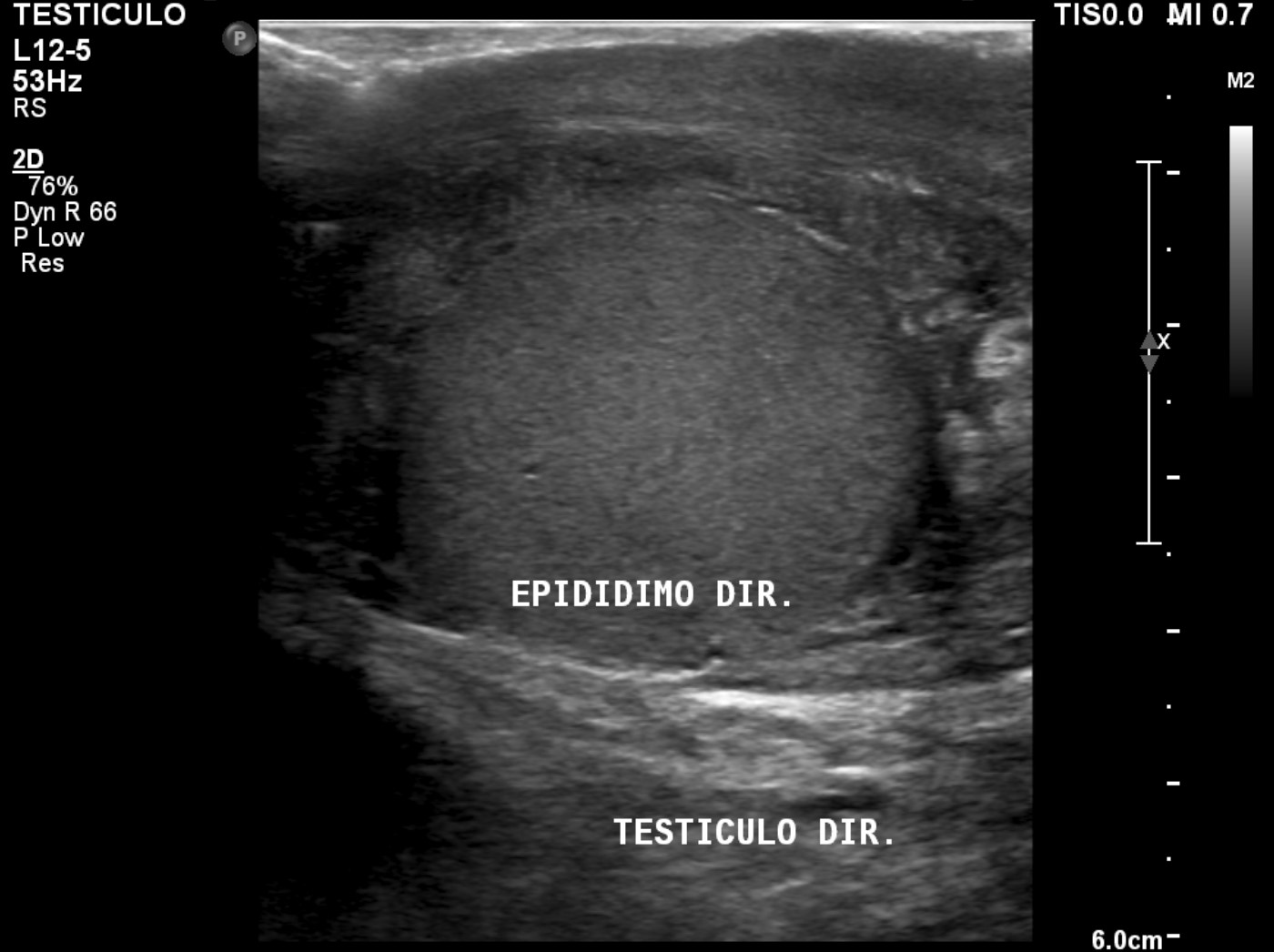 Ultrasound Of Scrotum