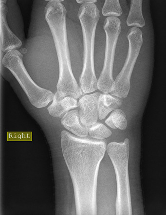 Scaphoid fracture | Radiology Case | Radiopaedia.org