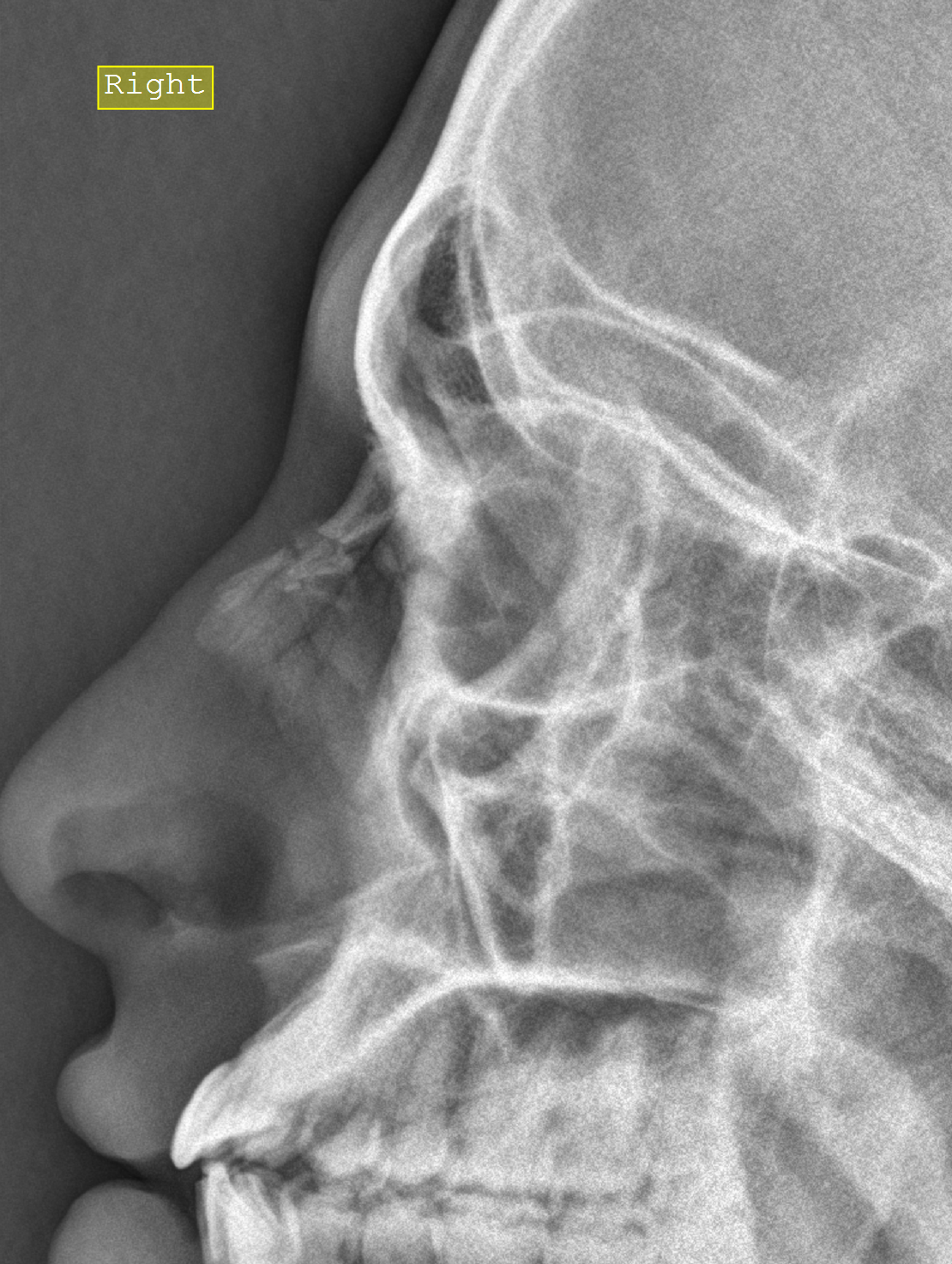 Nose Bone X Ray at Althea Lisa blog