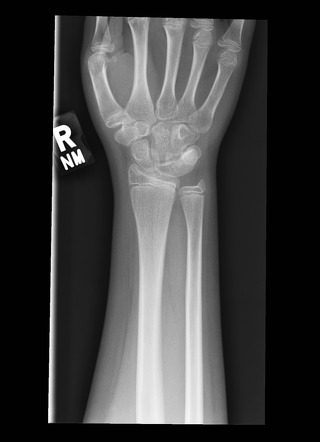 Lunotriquetral coalition | Radiology Case | Radiopaedia.org