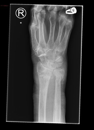 Distal radius and ulna fractures | Radiology Case | Radiopaedia.org