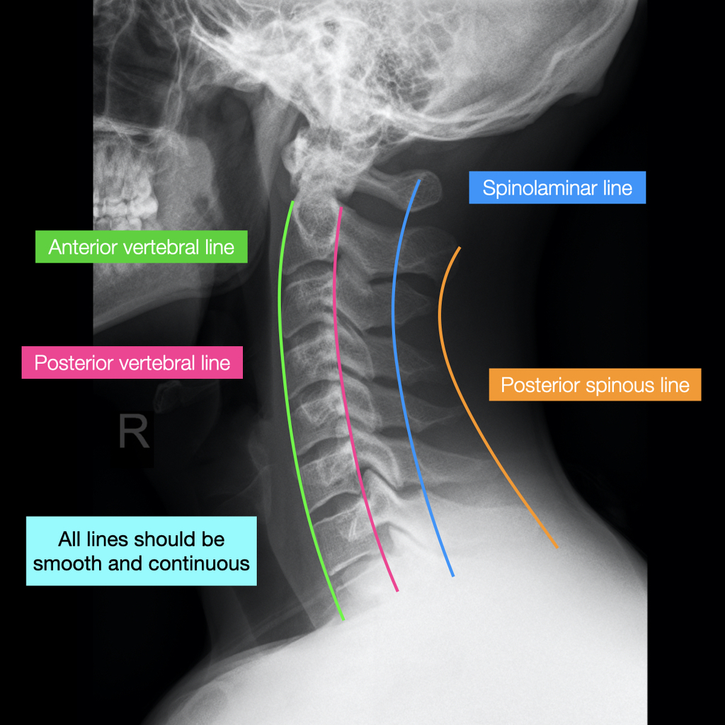 young vs old cervical spine x ray