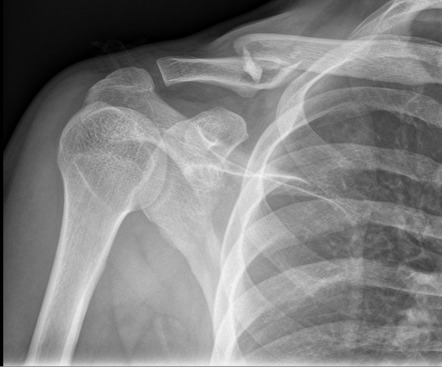 Clavicle fracture | Image | Radiopaedia.org