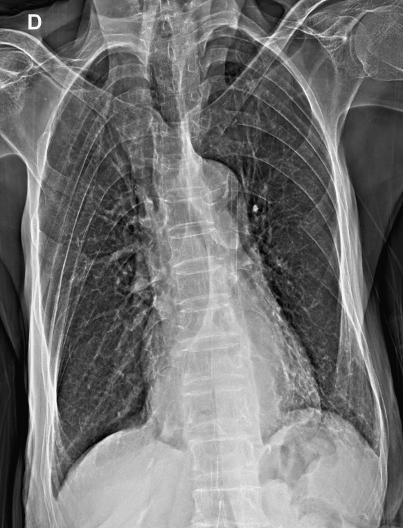 Hiatus Hernia With Organo-axial Volvulus Of Stomach 