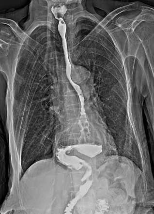 Hiatus hernia with organo-axial volvulus of stomach | Radiology Case ...