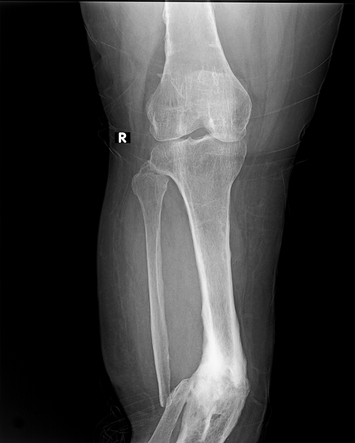 Malunited fracture - tibia, Radiology Case