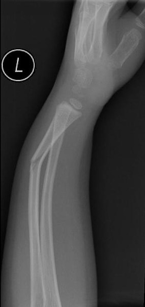 greenstick fracture x ray