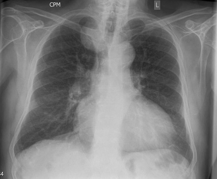 Aberrant right subclavian artery aneurysm | Radiology Case ...