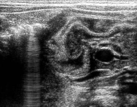 Congenital hypertrophic pyloric stenosis | Radiology Case | Radiopaedia.org