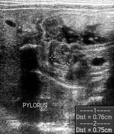 Congenital Hypertrophic Pyloric Stenosis Image Radiopaedia Org