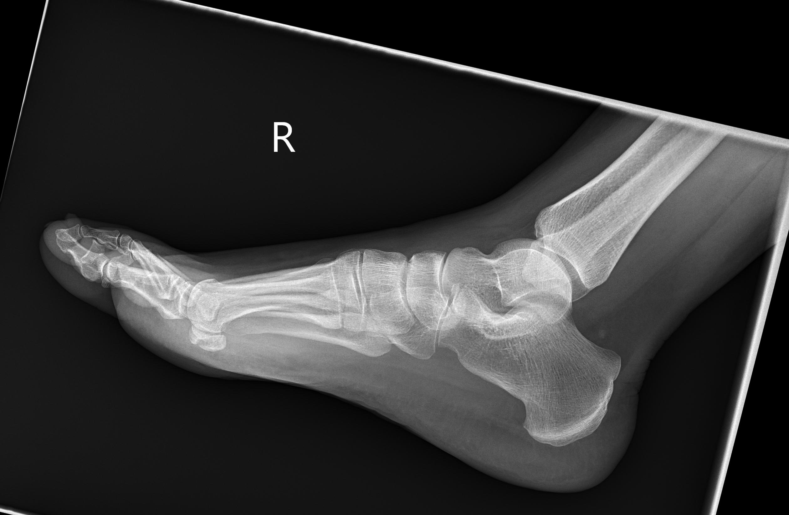 Anterior calcaneal process fracture | Image | Radiopaedia.org