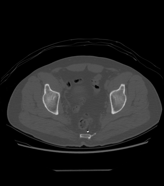 Sacral nerve stimulator | Image | Radiopaedia.org