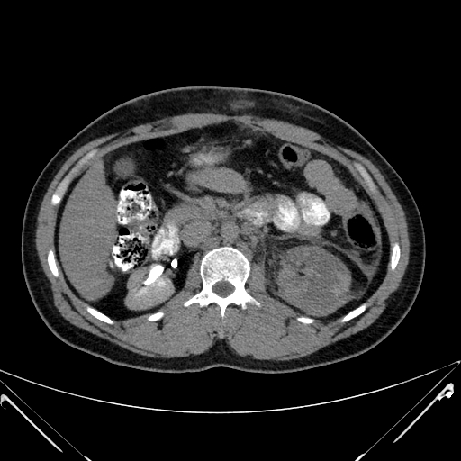 Polytrauma with high-grade renal and splenic injury | Image ...