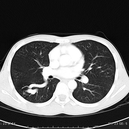 Pulmonary arteriovenous malformation | Radiology Reference Article ...