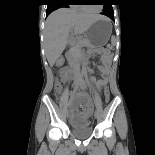 Appendicular abscess | Image | Radiopaedia.org