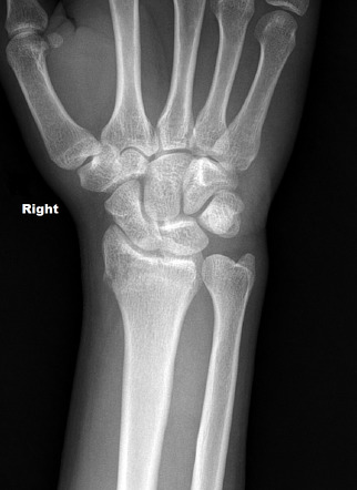 Distal Radial Fracture Radiology Case Radiopaedia Org