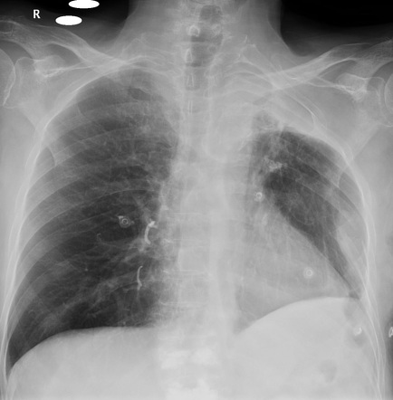 Pulmonary cement embolism | Radiology Case | Radiopaedia.org