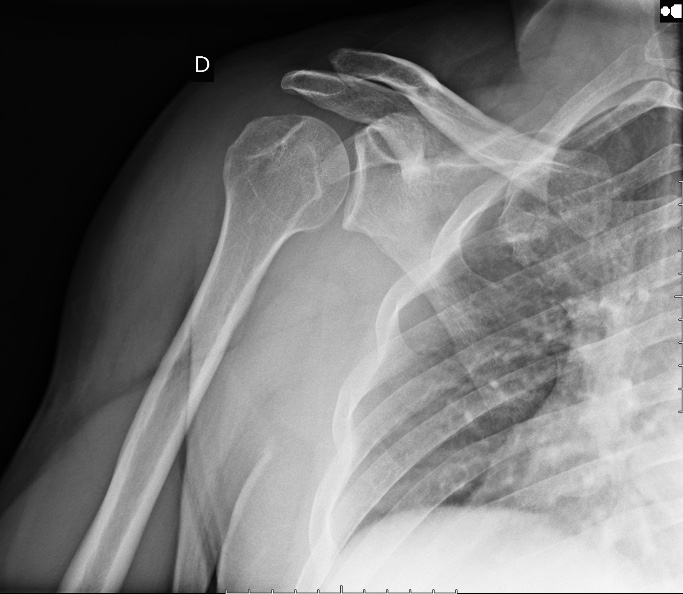 Anterior glenohumeral joint dislocation | Image | Radiopaedia.org