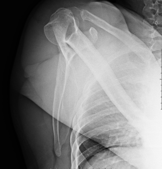 Anterior Glenohumeral Joint Dislocation | Image | Radiopaedia.org