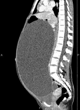 Ovarian serous cystadenoma | Radiology Case | Radiopaedia.org