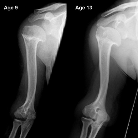 Premature Closure Of A Growth Plate Differential Radiology Reference Article Radiopaedia Org