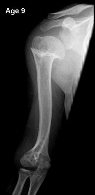 Premature closure of a growth plate differential Radiology