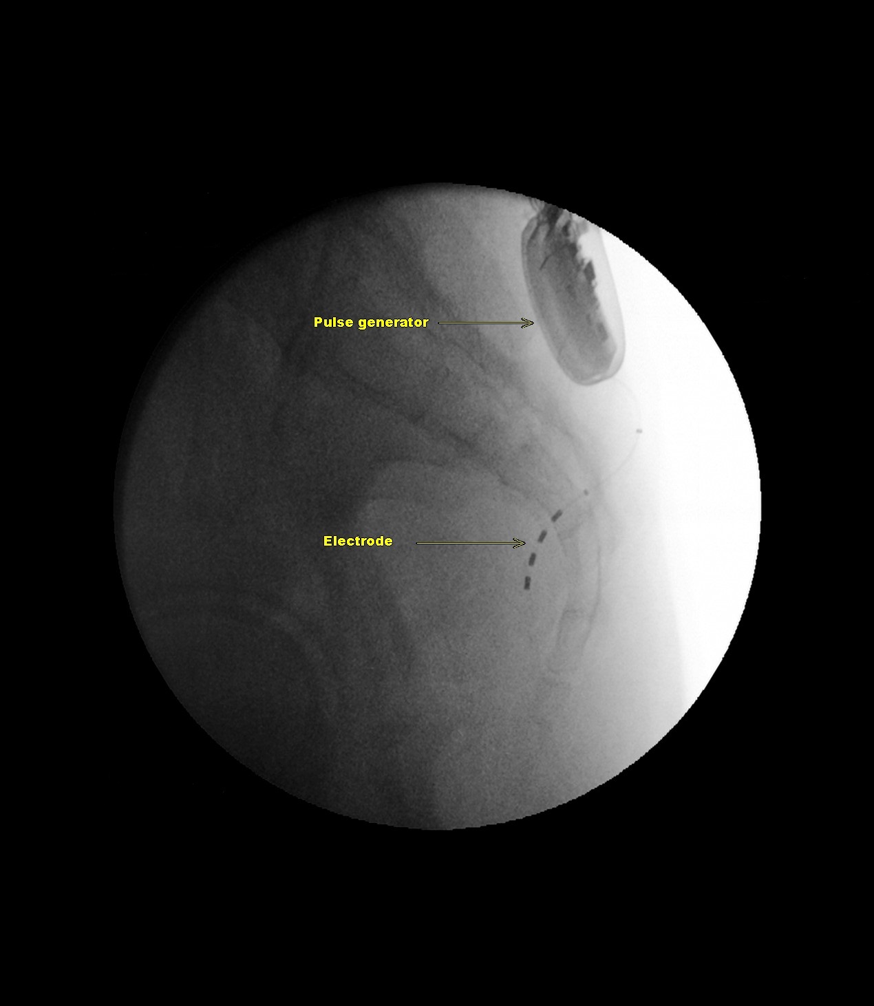 Sacral Nerve Stimulator | Image | Radiopaedia.org