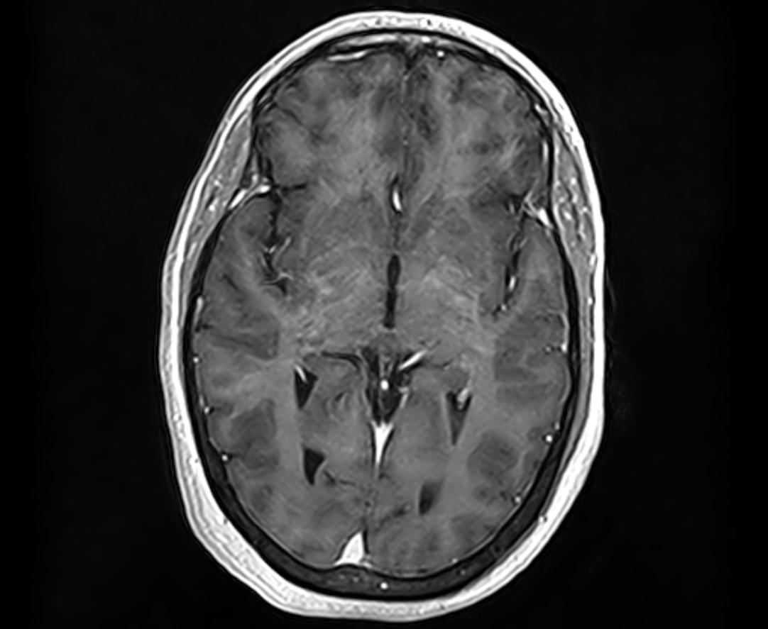 Meningioma - jugular foramen | Image | Radiopaedia.org