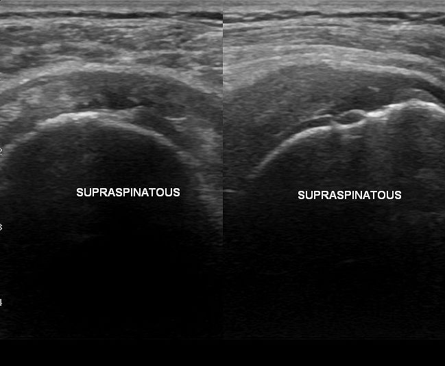 Infraspinatus calcific tendinosis (ultrasound) | Image | Radiopaedia.org