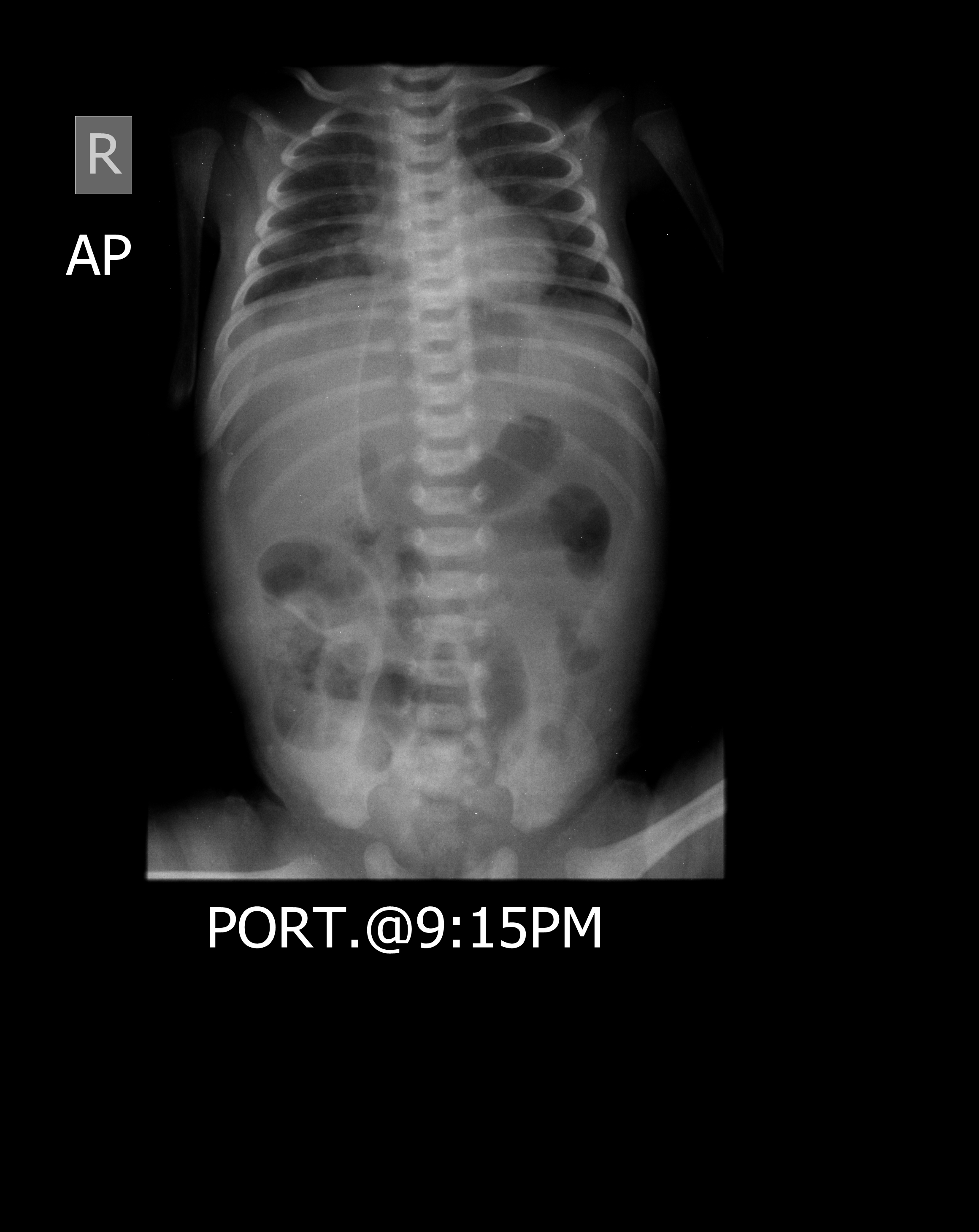 Pneumoperitoneum Related To Intestinal Perforation. | Image ...