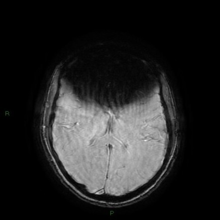 MRI artifact - dental braces | Image | Radiopaedia.org