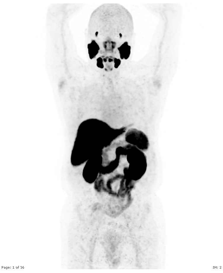 f-18-psma-pet-ct-normal-physiological-distribution-image