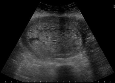 Complete hydatidiform mole | Image | Radiopaedia.org