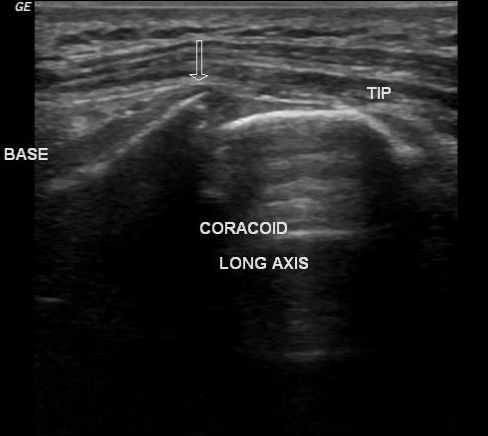 Coracoid process fracture | Image | Radiopaedia.org