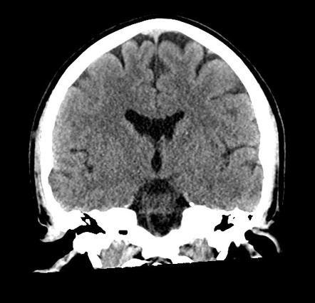 Cerebellar infarct due to vertebral artery dissection with posterior ...