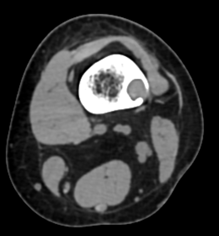 Ossifying Fibroma Femur