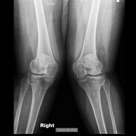 Genu valgum | Radiology Reference Article | Radiopaedia.org