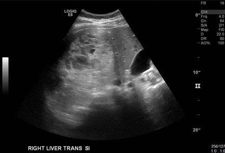 Undifferentiated embryonal sarcoma of the liver | Image | Radiopaedia.org