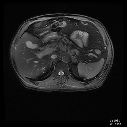 Focal Fat Infiltration Mimicking Liver Metastasis 