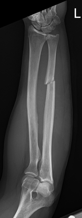 Nightstick fracture | Radiology Case | Radiopaedia.org